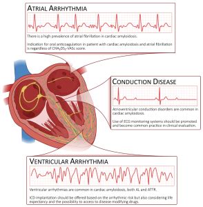 Heart Arrhythmia Types Symptoms Causes Treatment