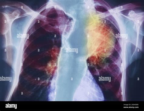 Lung Cancer Coloured Chest X Ray Of A 70 Year Old Woman Showing Cancer Yellow At Upper Right