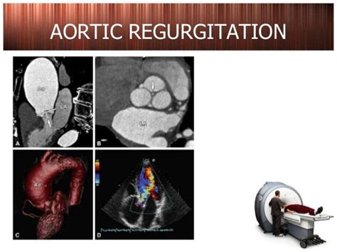 Ct Scan Pada Penyakit Jantung Katup