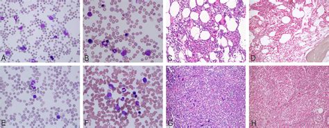 Clinicopathologic Spectrum Of Myeloid Neoplasms With Concurrent