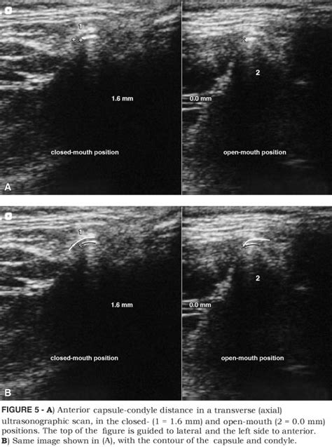 Scielo Brasil Ultrasonographic Findings In Normal Temporomandibular