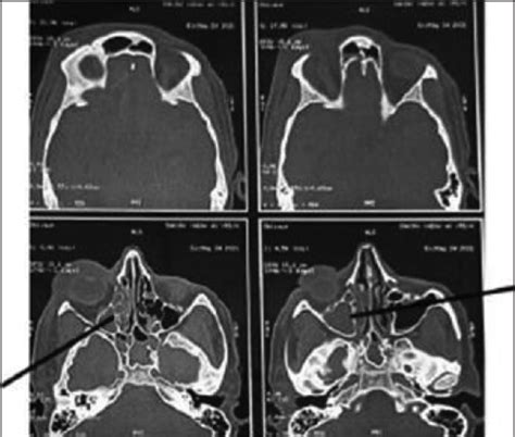 Laboratory Diagnosis Of Mucormycosis Present Perspective Pmc