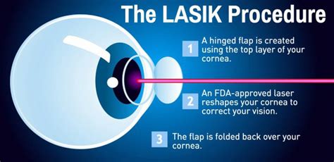 Laser Assisted In Situ Keratomileusis