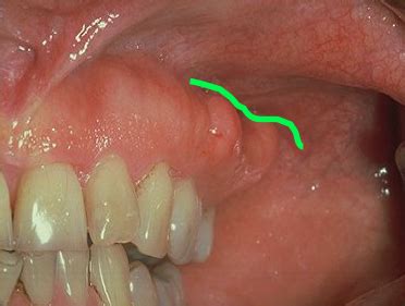 Ch Oral Cavity Flashcards Quizlet