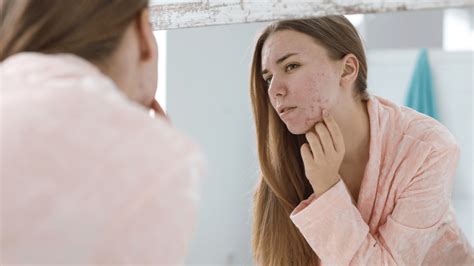 Rosacea Vs Acne Differences In Causes And Treatment Gladskin