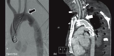 A Digital Subtraction Angiography Demonstrating A Covered