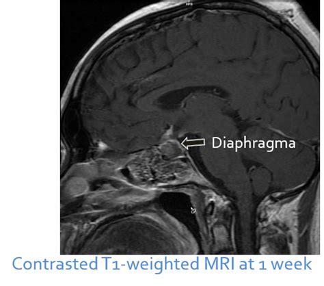 Diaphragma Sellae Mri