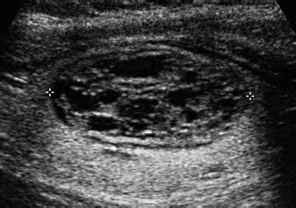 Ultrasound of Thyroid Nodules | Radiology Key