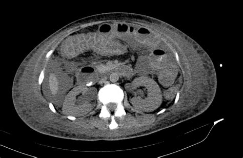 Pseudomembranous Colitis Image Radiopaedia Org