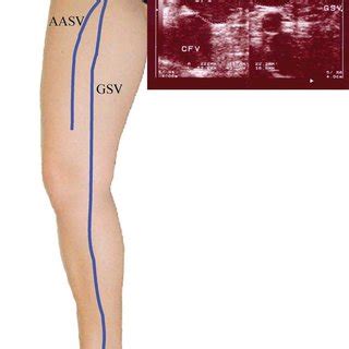 Great saphenous vein (GSV) and small saphenous vein (SSV) terminal ...