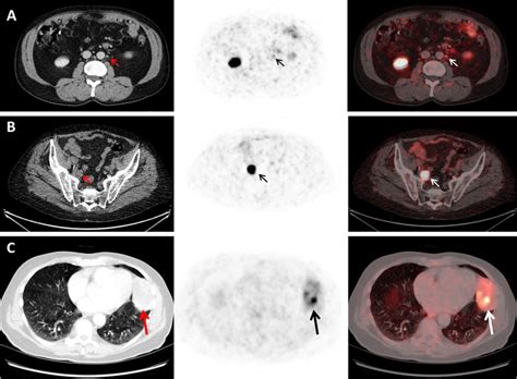What Is Undetectable Psa After Radical Prostatectomy