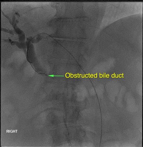 Blocked Bile Ducts – PTC – Sydney Medical Interventions