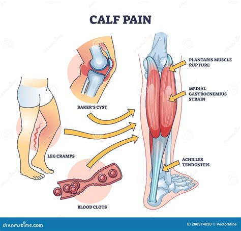 Calf Pain Explanation With Cramp From Muscle Contraction Outline