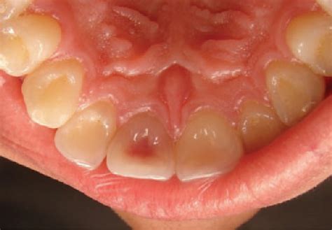 Figure 1 From Double Pink Tooth Associated With Extensive Internal Root Resorption After