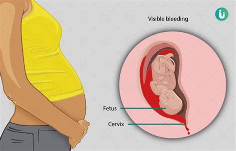 प्रेगनेंसी में ब्लीडिंग क्यों होती है प्रेगनेंसी में ब्लीडिंग के