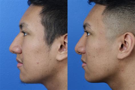 Asian Rhinoplasty New York City New York Dr Philip Miller