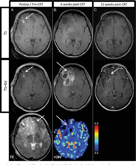 Figure From Evaluation Of Pseudoprogression In Patients With