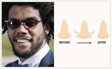 Male Rhinoplasty Vive Aesthetic Nose Surgery