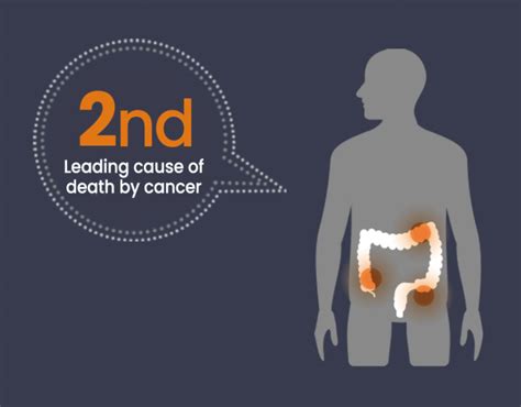 Importance Of The Early Detection Of Colorectal Cancer Colon Cancer