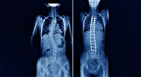 A Scoliosis Overview Treatments Pain Relief Rocky Mountain Brain