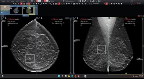 Advances In Mammography Among Breast Cancer Update Topics