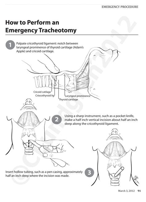 Successful intubation position – Artofit