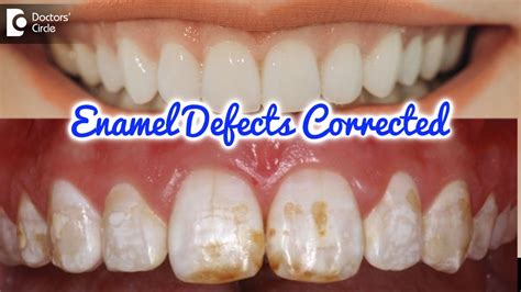 Great Way To Correct Enamel Defects Amelogenesis Imperfecta Dr Shahul