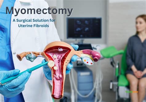 Myomectomy A Surgical Solution For Uterine Fibroids