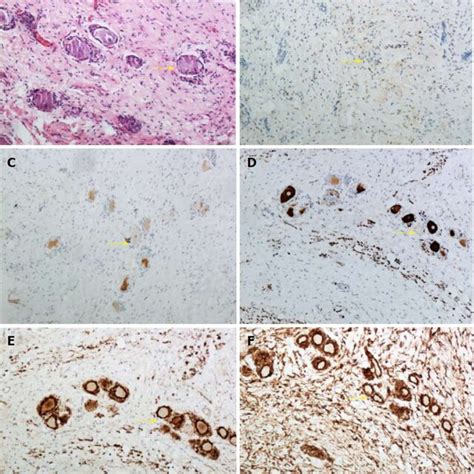 Histopathology Of The Resected Lesion A Hematoxylin And Eosin