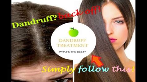 How To Fight And Prevent Dandruff Dealing With Dandruff Youtube