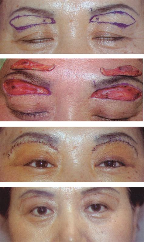 Eyelid Surgery by Prof Dr CN CHUA 蔡鐘能: Doctor, could you lift my ...