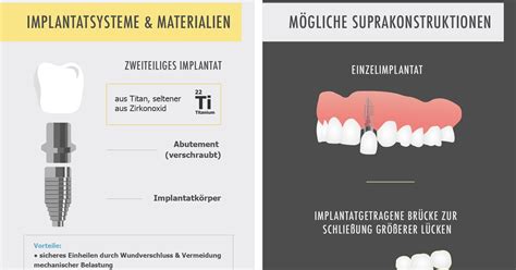 Wie L Uft Eine Zahnimplantation Ab Schritt F R Schritt Erkl Rt