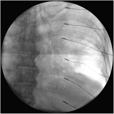 Flouroscopic Image Of Implanted StimRouter Peripheral Nerve Stimulation