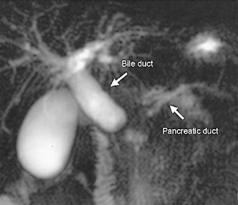 Figure From Ercp And Mrcp In The Differentiation Of Pancreatic Tumors