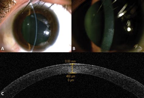 A And B Clinical Image With Resolution Of Corneal Edema In The Right