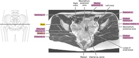 Mri Of The Female Pelvis Radiology Key