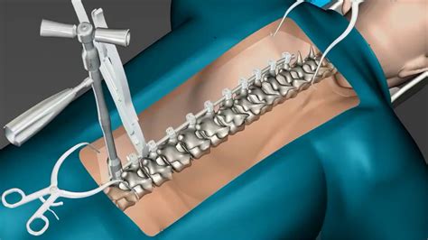 Cirurgia De Curvatura Da Coluna Youtube