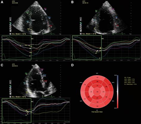 Quantitative Assessment Of Systolic Left Ventricular Function With