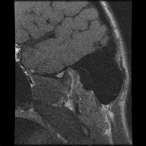 Temporomandibular Joint With Anterior Disc Dislocation And Recapture Image