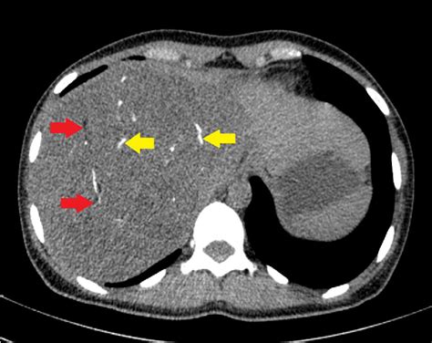 Figure 2 From Primary Immature Teratoma Of The Liver In An Adult Case