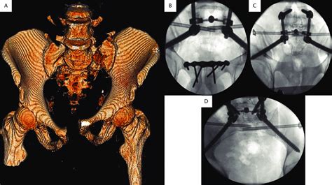 A Three Dimensional Pelvic Model Showing Bilateral Sacral Fractures Download Scientific