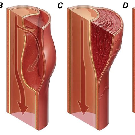 Illustration Shows Longitudinal Sections Of The Aortic Lumen And Wall