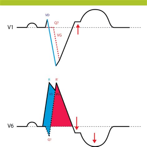 Diagnostic ECG De Linfarctus En Cas De Bloc De Branche Gauche Connu Ou