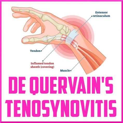 De Quervain Tendinopathy