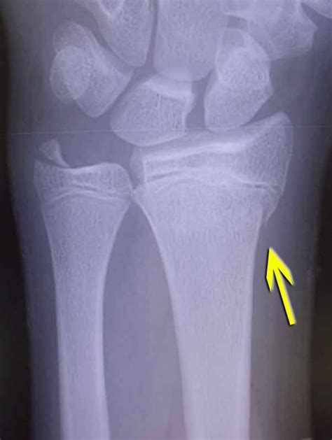 Buckle Fracture : Causes, Symptoms And Treatment