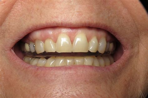 Teeth Grinding or Bruxism — Stephen Johansen Dentistry