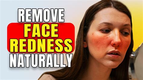 Best Rosacea Treatment How To Get Rid Of Redness On Face Youtube