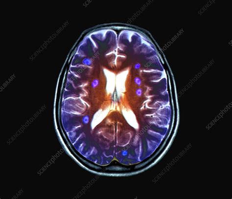 Secondary Brain Cancer Mri Scan Stock Image C Science