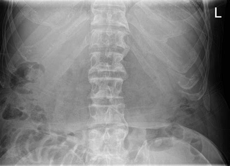 Small Bowel Obstruction Due To Left Inguinal Hernia Image