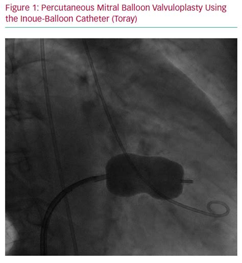 Percutaneous Mitral Balloon Valvuloplasty Using The Inoue Balloon